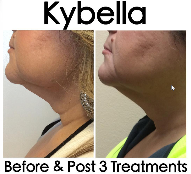 KYBELLA® - DeSoto, TX