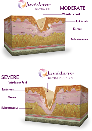 Juvéderm® Ultra in DeSoto, TX