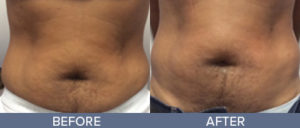 Body Contouring Gallery