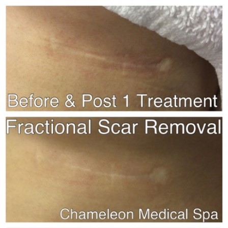 Fractional skin resurfacing in DeSoto, TX