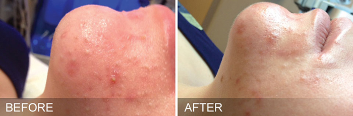 HydraFacial® Before and After Dallas HydraFacial® Before and After Dallas