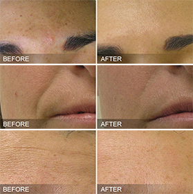 Hydrafacial® Before and After Dallas