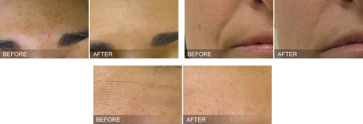HydraFacial® Before and After Dallas