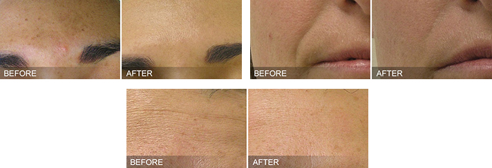 HydraFacial® Before and After Dallas HydraFacial® Before and After Dallas