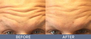 Injectables Gallery