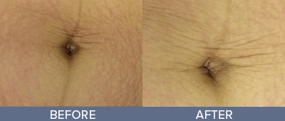 Fractional Stretch Mark Removal Before and After, DeSoto, TX