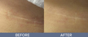 Laser and Light Treatments Gallery