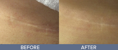 Fractional Scar Removal Before and After, DeSoto, TX