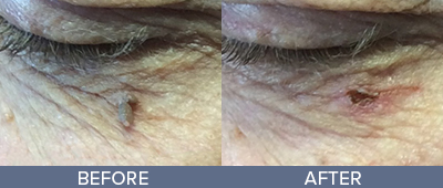 Fractional Scar Removal Before and After, DeSoto, TX