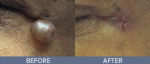 Laser and Light Treatments Gallery