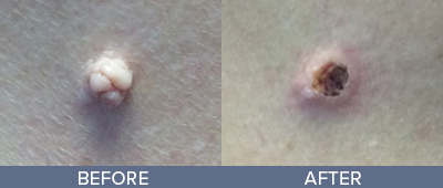 Cyst Removal Before and After, DeSoto, TX
