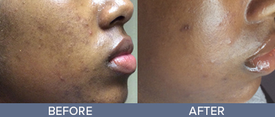 Microdermabrasion Before and After, DeSoto, TX