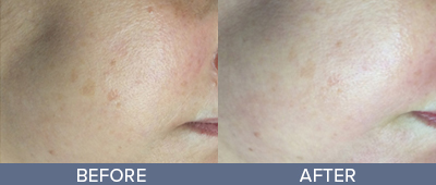 Illuminating Facial Before and After, DeSoto, TX