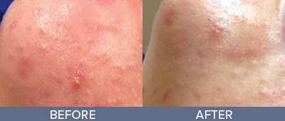 HydraFacial Before and After, DeSoto, TX