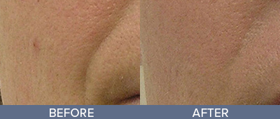 HydraFacial Before and After, DeSoto, TX