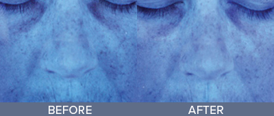 HydraFacial Before and After, DeSoto, TX