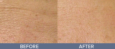 HydraFacial Before and After, DeSoto, TX