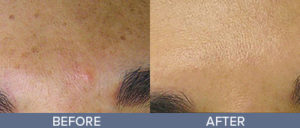 Skin Rejuvenation Gallery
