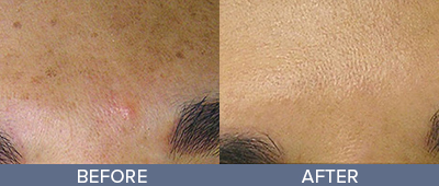 HydraFacial Before and After, DeSoto, TX