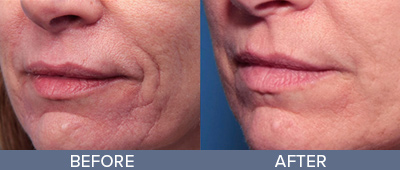 Genius RF Microneedling Skin Rejuvenation DeSoto Texas