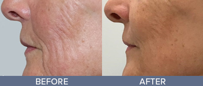 Genius RF Microneedling Skin Rejuvenation DeSoto Texas