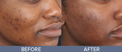 Genius RF Microneedling Skin Rejuvenation DeSoto Texas