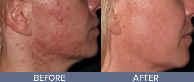 Genius RF Microneedling Skin Rejuvenation DeSoto Texas