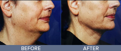 Genius RF Microneedling Skin Rejuvenation DeSoto Texas