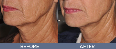 Genius RF Microneedling Skin Rejuvenation DeSoto Texas