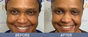 Genius RF Microneedling Skin Rejuvenation Gallery