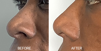 Non-Surgical Nose Job Dallas