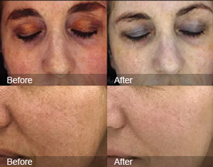 Complex Skin Serum Facials  Dallas