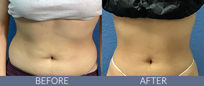 Body Sculpting Before and After, DeSoto, TX