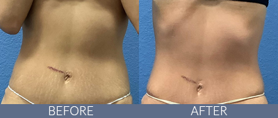 Body Sculpting Before and After, DeSoto, TX