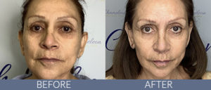 Genius RF Microneedling Skin Rejuvenation Gallery