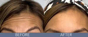 Injectables Gallery
