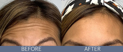Injectables Before and After, DeSoto, TX
