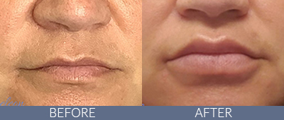 Injectables Before and After, DeSoto, TX