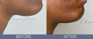 Injectables Gallery
