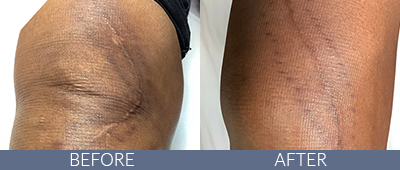 Scar Reduction Before and After, DeSoto, TX