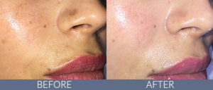 Laser and Light Treatments Gallery