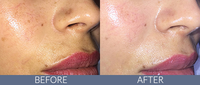 IPL Skin Rejuvenation Before and After, DeSoto, TX