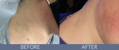 Skin Rejuvenation Before and After, DeSoto, TX