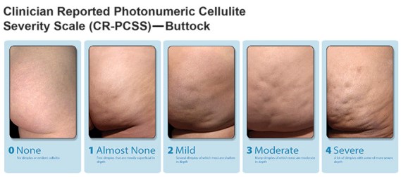 5 photos of cellulite indicating increasing severity