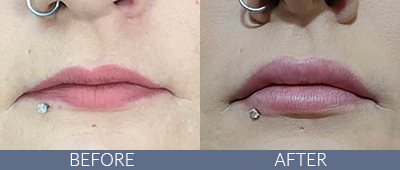 Injectables Before and After, DeSoto, TX