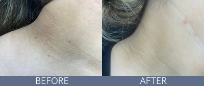 Skin Tag Removal Before and After, DeSoto, TX