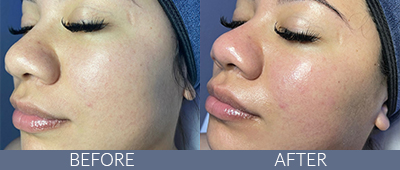 Skin Rejuvenation Before and After, DeSoto, TX