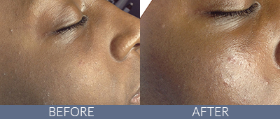 Skin Rejuvenation Before and After, DeSoto, TX