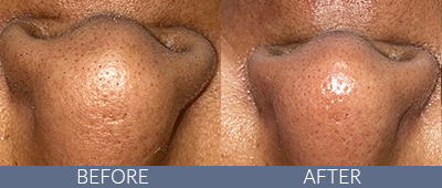 Skin Rejuvenation Before and After, DeSoto, TX