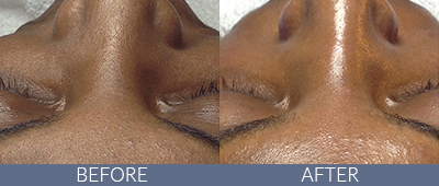 Skin Rejuvenation Before and After, DeSoto, TX